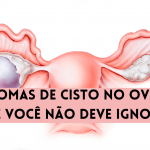 5 sintomas de cisto no ovário que você não deve ignorar