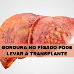 Gordura no fígado pode levar até a transplante