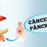 Estes são os Sintomas do Câncer de Pâncreas que você não deve ignorar!